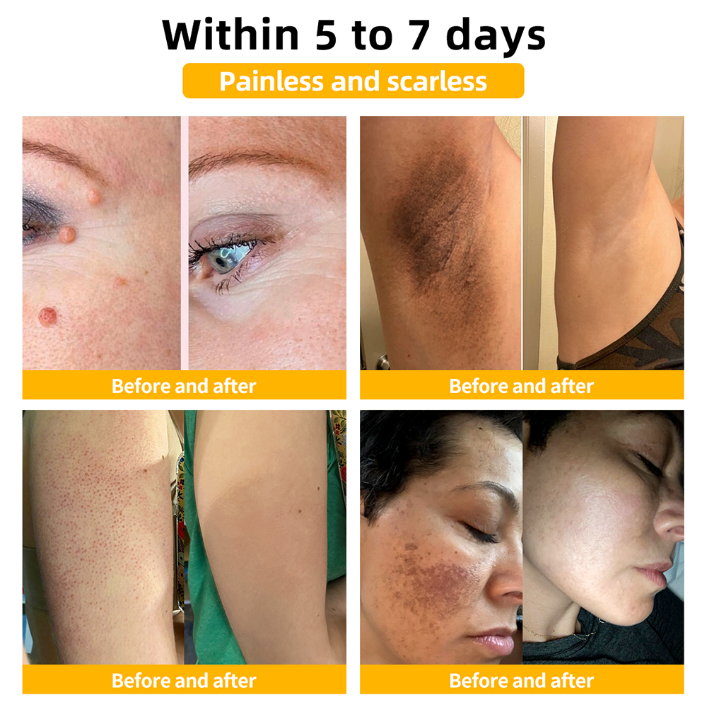 ThinkFlye™ Bee Venom Skin Treatment Cream（𝐴𝐴𝐷 𝑅𝑒𝑐𝑜𝑚𝑚𝑒𝑛𝑑𝑒𝑑）