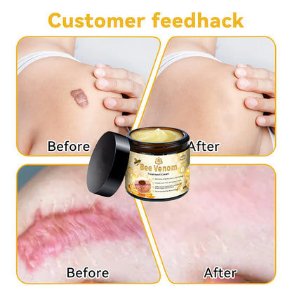 ThinkFlye™ Bee Venom Skin Treatment Cream（𝐴𝐴𝐷 𝑅𝑒𝑐𝑜𝑚𝑚𝑒𝑛𝑑𝑒𝑑）