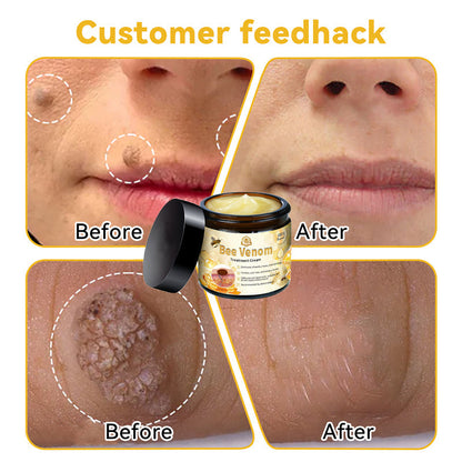 ThinkFlye™ Bee Venom Skin Treatment Cream（𝐴𝐴𝐷 𝑅𝑒𝑐𝑜𝑚𝑚𝑒𝑛𝑑𝑒𝑑）